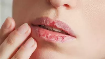 تشقق الشفاه .. الأسباب الشائعة وطرق الوقاية والعلاج