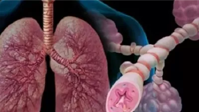 محفزات غير متوقعة لنوبات الربو قد تواجهها يوميًا دون أن تنتبه