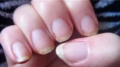 تقصف وتكسر الأظافر .. الأسباب وطرق العلاج