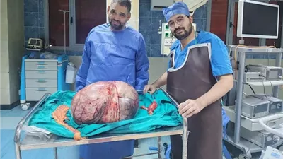 استئصال ورم مبيضي عملاق يزن 24 كيلوجرامًا داخل مستشفى الجامعي