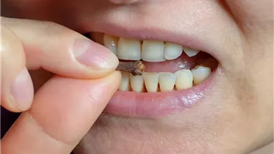 فوائد القرنفل للأسنان.. مضاد للالتهاب ومسكن ومقاوم للبكتيريا