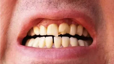 تعرف على أسباب تغير لون أسنانك