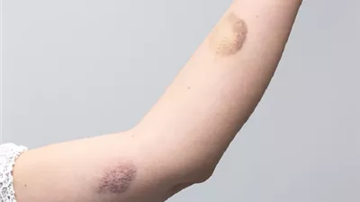 كدمات مفاجئة دون سبب .. علامة قد تكشف مرضا خطيرا