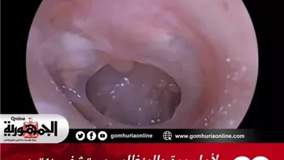مستشفى بهتيم المركزي تنجح في إجراء عملية ترقيع ثقب بطبلة الأذن