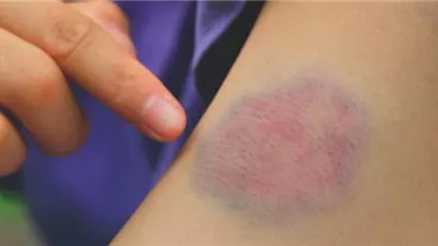 اكتشاف آلية تسبب جلطات خطيرة بعد استخدام الهيبارين