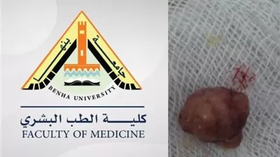 نجاح استئصال ورم بالقولون بالمنظار في جامعة بنها