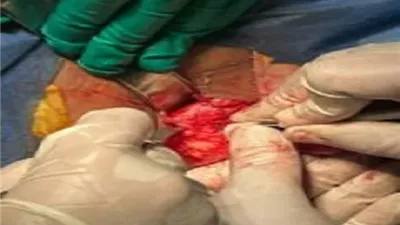 جراحة دقيقة لاستئصال وإعادة بناء جزء من فك مريضة