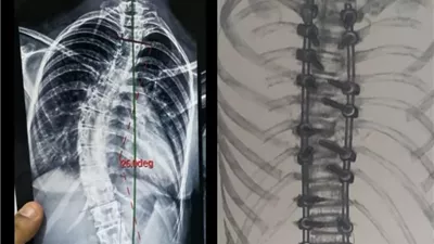 جراحة معقدة تنقذ طفلًا من اعوجاج حاد بالعمود الفقري في جامعة بنها