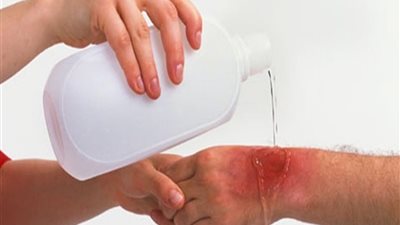 6 طرق طبيعية لعلاج الحروق في المنزل.. منها استخدام الخل
