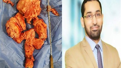 بالصور .. لأول مرة ببنها اسـتئصال ورم ضخم من رحم سيدة بالمنظار الجراحى