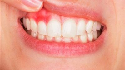 علاجات منزلية تساعدك على تخفيف الام الاسنان والتئام الجروح