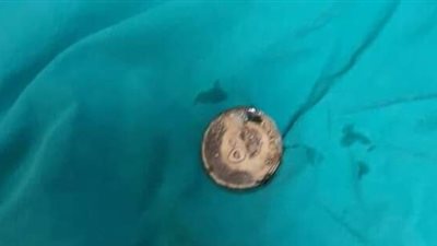 إنقاذ 3 أطفال بمستشفى الأقصر الدولى بعد إبتلاعهم عملات معدنية