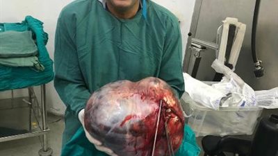 استئصال ورم يزن 37 كجم من بطن سبعينية