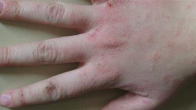 اكتشاف سبب تطور سرطان خطير وطريقة علاجه