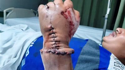 زرع يد مبتورة وعمليات متميزة بالعمود الفقرى بالمستشفيات الجامعية بأسيوط..بالصور