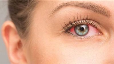 التهاب الملتحمة يهددك بالعمى.. أعراضه وطريقة علاجه