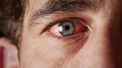 6 طرق طبيعية لعلاج حساسية العين