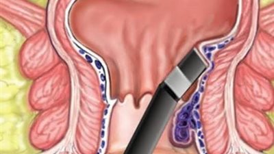 أسباب الإصابة بالبواسير