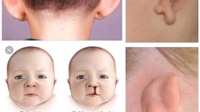 استضافة وحدة لجراحات أورام وتجميل الوجه بمستشفى النجيله 29 يناير