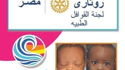 روتاري مصر يستقدم فريق طبي أمريكي لعلاج الشفة الأرنبية 13 مارس