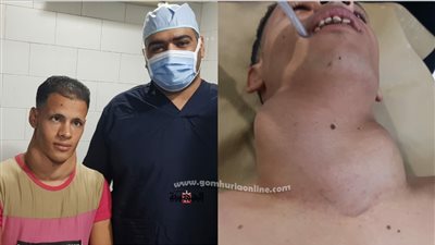 استئصال ورم بالغدة الدرقية لشاب في عقده الثاني بمعهد جنوب مصر للأورام
