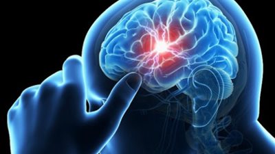 أعراض خطيرة تعرضك لجلطة دماغية وشيكة.. احذرها