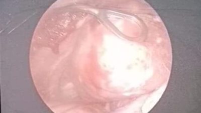 استئصال كيس هوائى بالرئه بالمنظار