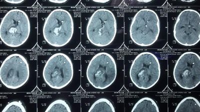 لأول مرة فريق جراحي ينقذ حياة طفلة مصابة بنزيف في بطينات المخ بالدقهلية