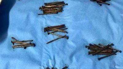 انقاذ حياة مريض بلع 230 مسمارا وقطع زجاجية.. تفاصيل