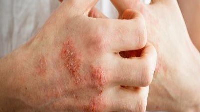 4 أمراض جلدية تنتشر في الشتاء.. منها الصدفية