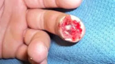 بتر اصابع صراف التذاكر بعد سقوطة من قطار بالمنصورة