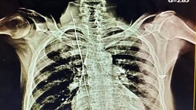 نجاح جراحة دقيقة لمريض كورونا بالسويس