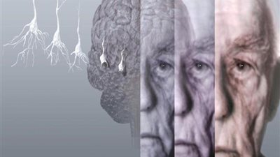 5 جينات جديدة تزيد خطر الإصابة بالزهايمر
