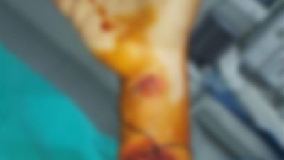 إجراء جراحة لإعادة يد طفلة بعد تعرضها لقطع كامل بإسنا جنوب الأقصر