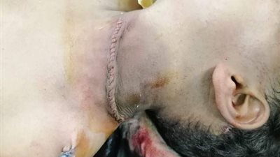 استئصال ورم خلقى بالرقبة لطفل عمره 8 سنوات بمستشفى أسوان الجامعي ..صور