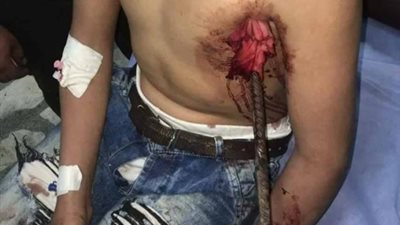 فريق جراحى بجامعة طنطا يتمكن من استخراج سيخ حديدى نافذ لطفل من الصدر للرقبة