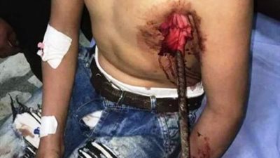 فريق جراحى بجامعة طنطا يتمكن من استخراج سيخ حديدى نافذ لطفل من الصدر للرقبة