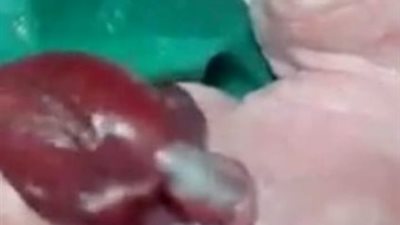 سيدة بطهطا بسوهاج تضع 3 توائم بينهم طفلة قلبها خارج جسدها