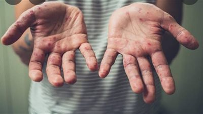 البيت الأبيض يعلن شراء 500 ألف جرعة إضافية من لقاح جدري القرود