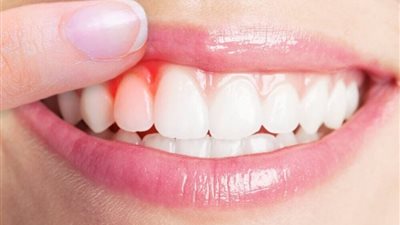 احترس من التهابات اللثة فقد تؤدي لأمراض خطيرة يجب تفاديها