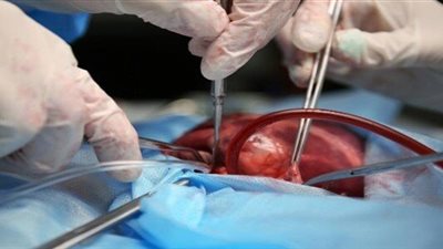 إجراء اول عملية زرع قلب في العالم بين مصابين بفيروس نقص المناعة