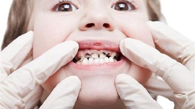 تعرف على أسباب وطرق الوقاية من تسوس الأسنان لدى الطفل