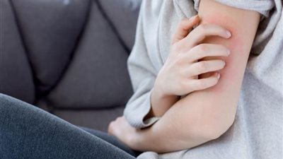 طرق طبيعية للتخلص من الجرب