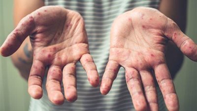 مرض جديد معد ومخيف.. إصابة 82 طفلاً بالهند