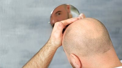 لا صلع بعد اليوم.. حبة صغيرة ورخيصة من علاج قديم تحدث فرقا