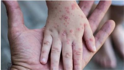 الولايات المتحدة تجري تجارب أولية لاستخدام عقار في علاج 