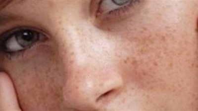 نصائح حول علاج النمش بالليزر