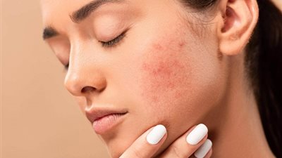 3 اسباب لظهور الحبوب في الوجه
