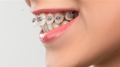 طرق علاج بروز الأسنان الأمامية