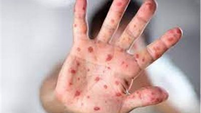 هل يتحول جدرى القرود الى جائحة مثل كورونا .. الصحة تكشف